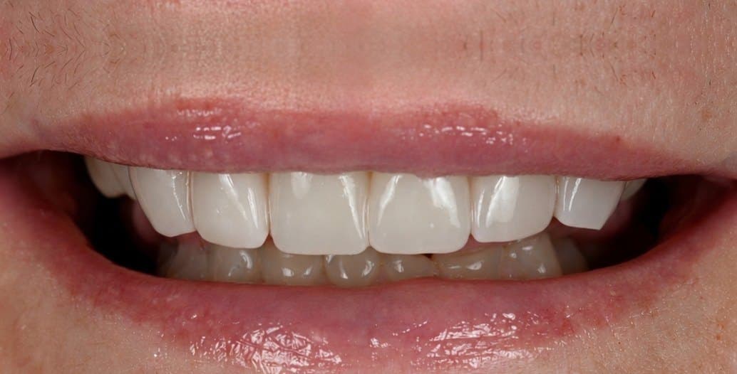 After treatment, case 1