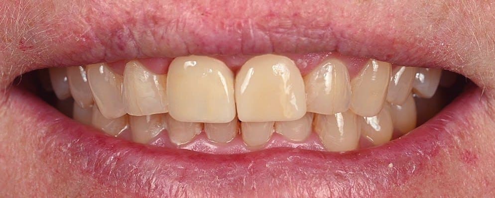 After treatment, case 2