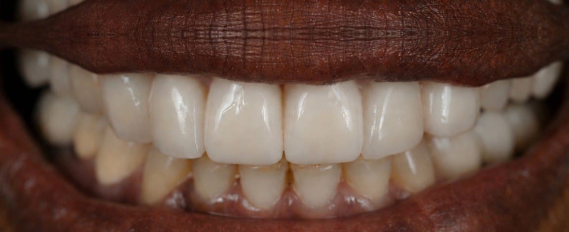 After treatment, case 3