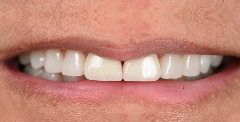 After treatment, case 4