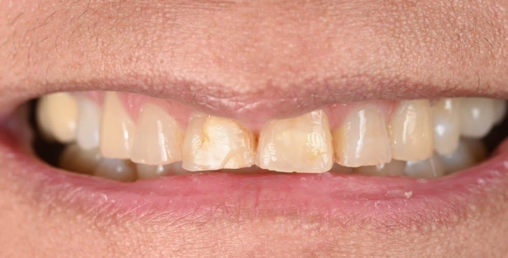 Before treatment, case 4